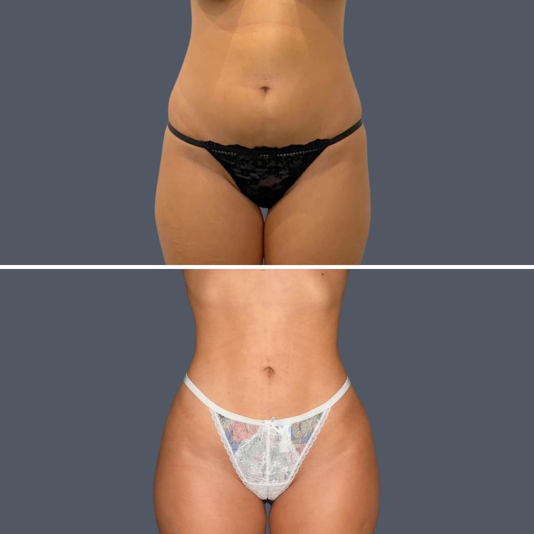 gold coast bbl liposuction female Feb 2024 005 before and after before and after