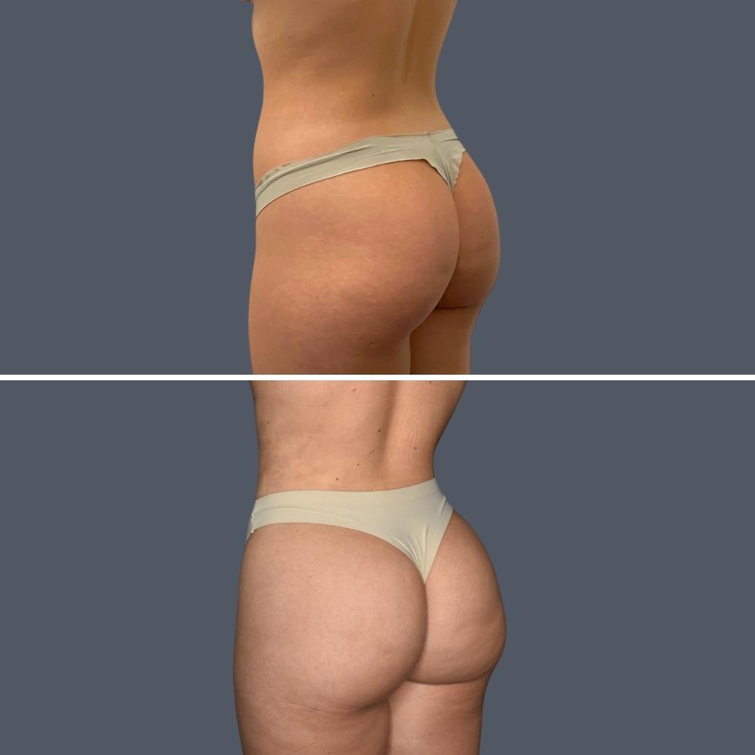 gold coast bbl liposuction female Feb 2024 011 before and after before and after