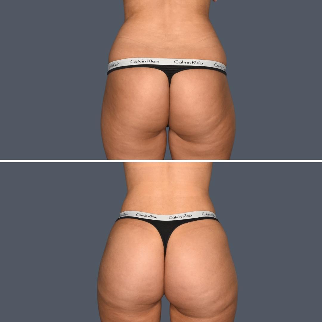 gold coast bbl liposuction female Feb 2024 039 before and after before and after