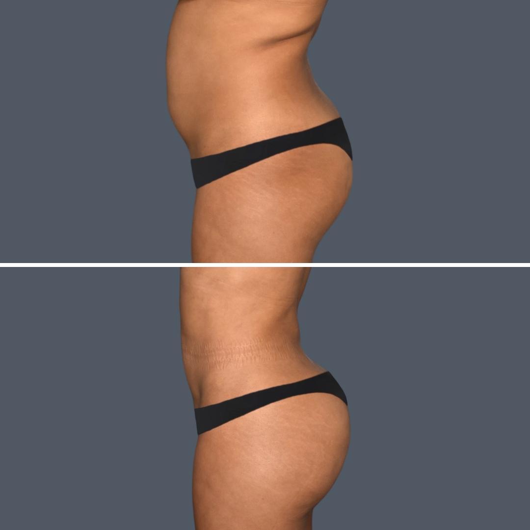gold coast bbl liposuction female Feb 2024 065 before and after before and after