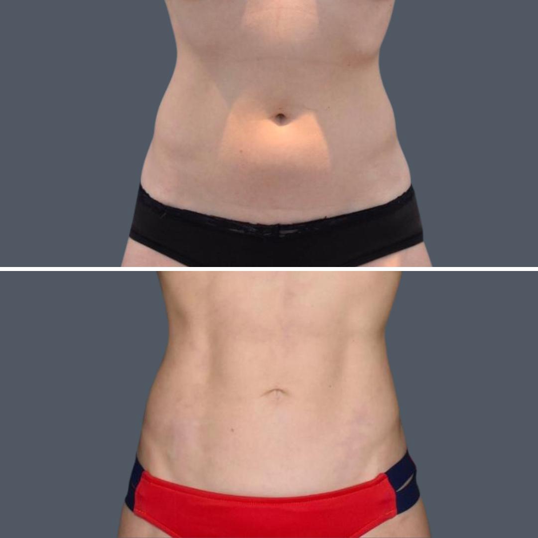 goldcoast vaserhidefliposuction stomach female 2023 front 205 before and after 001 before and after