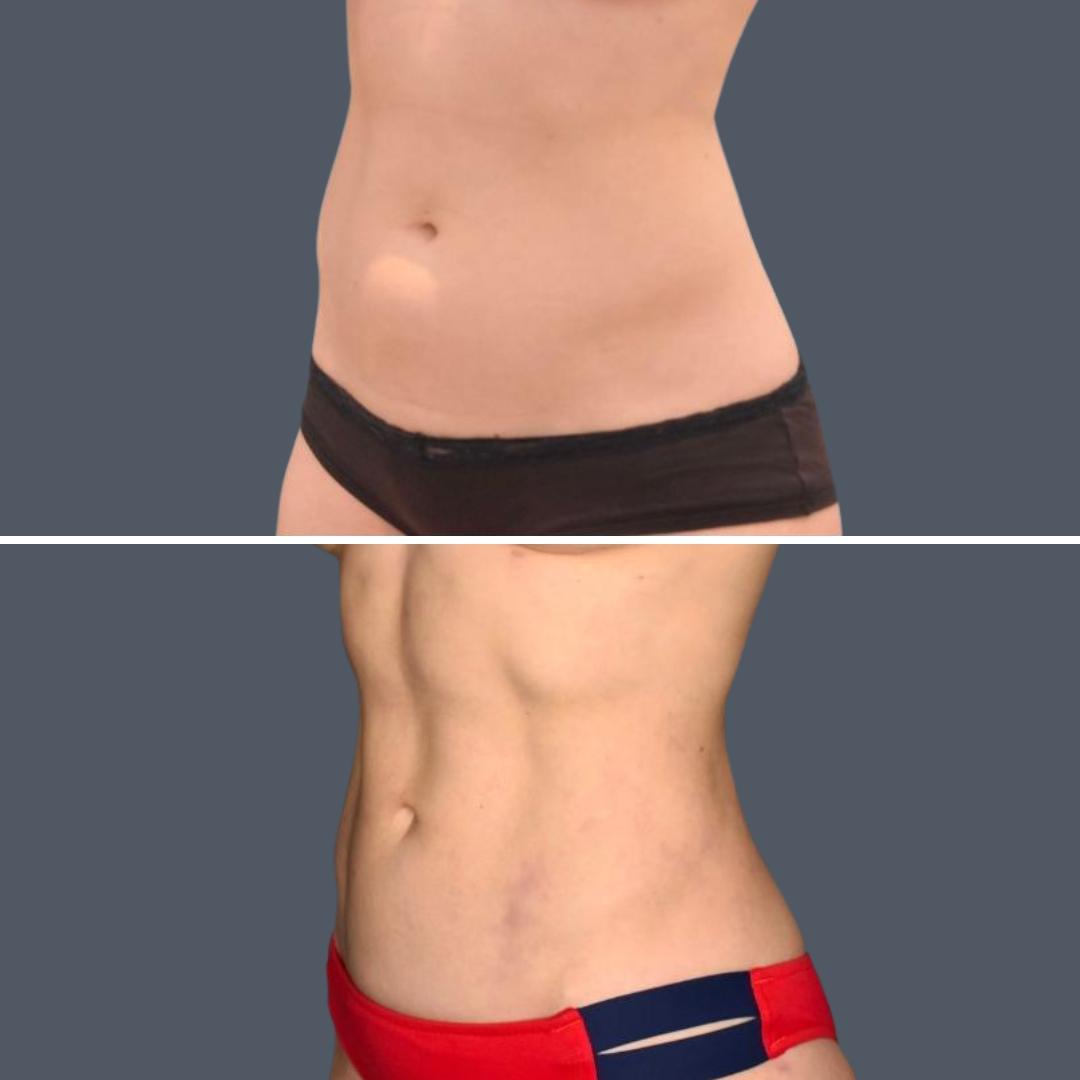 goldcoast vaserliposuction stomach female 2023 right 205 before and after before and after