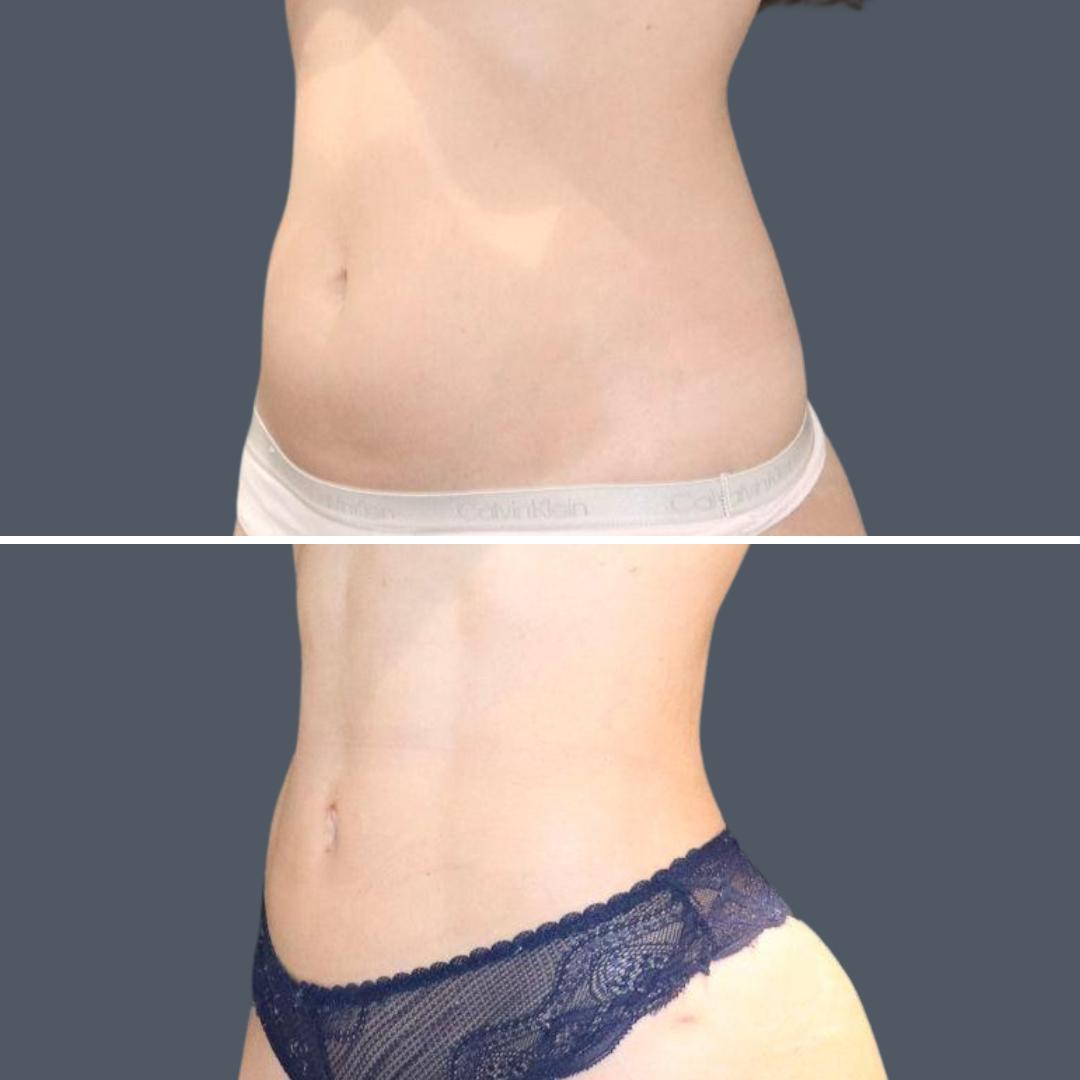 sydney vaserhidefliposuction stomach female 2021 right re before and after before and after