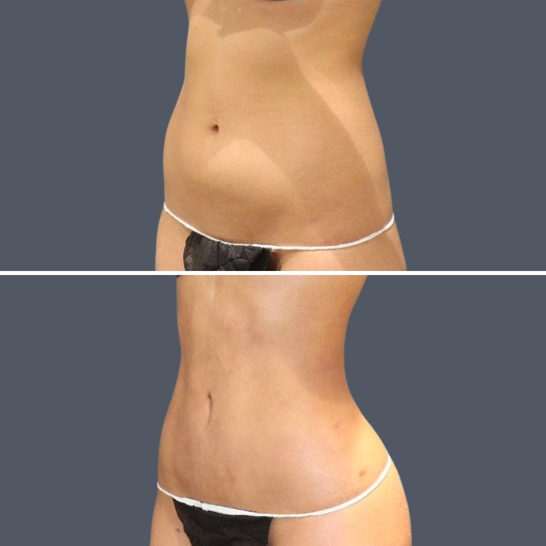 sydney vaserhidefliposuction stomach female 2021 right sm before and after before and after