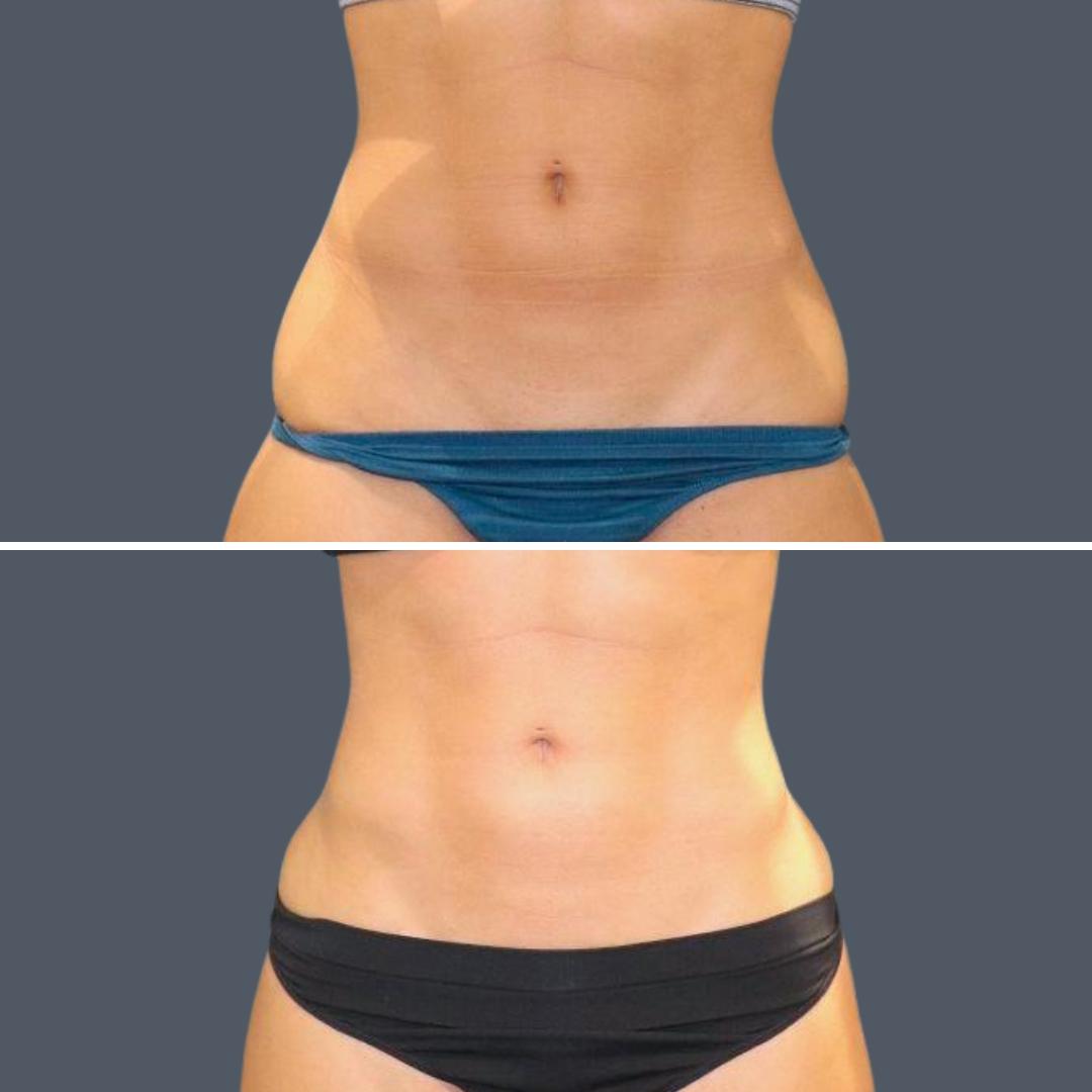 sydney vaserhidefliposuction stomach female 2022 front rc before and after before and after