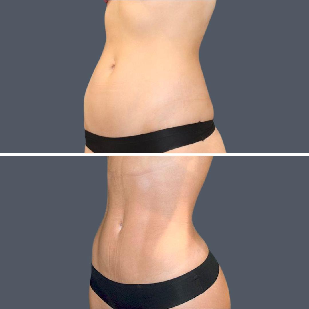sydney vaserhidefliposuction stomach female 2022 right rl before and after before and after