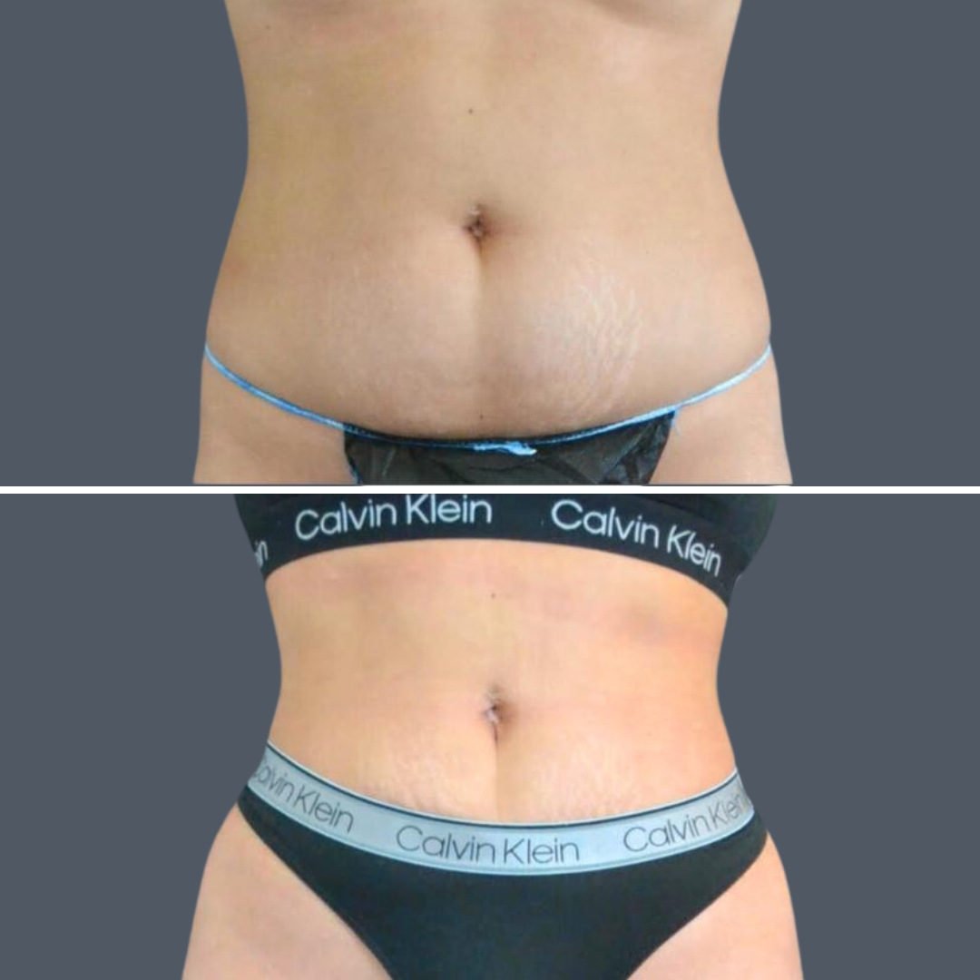 canberra stomach liposuction female 2024 kp 001 before and after before and after